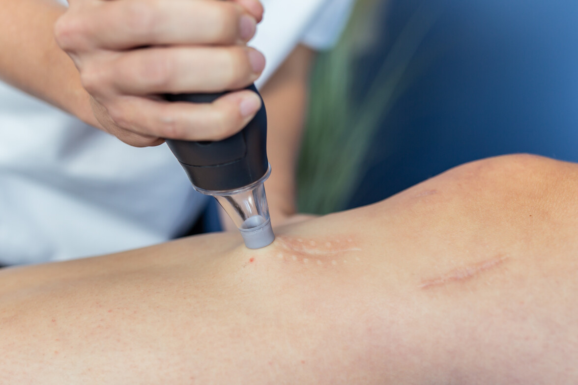 LymphaTouch® negative pressure therapy being used on a healed surgical scar.