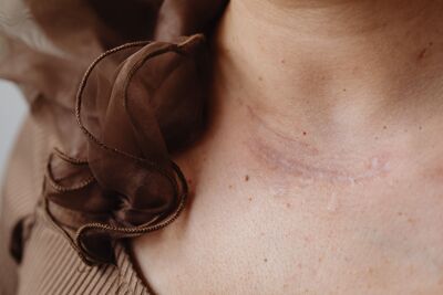 Woman with neck scar